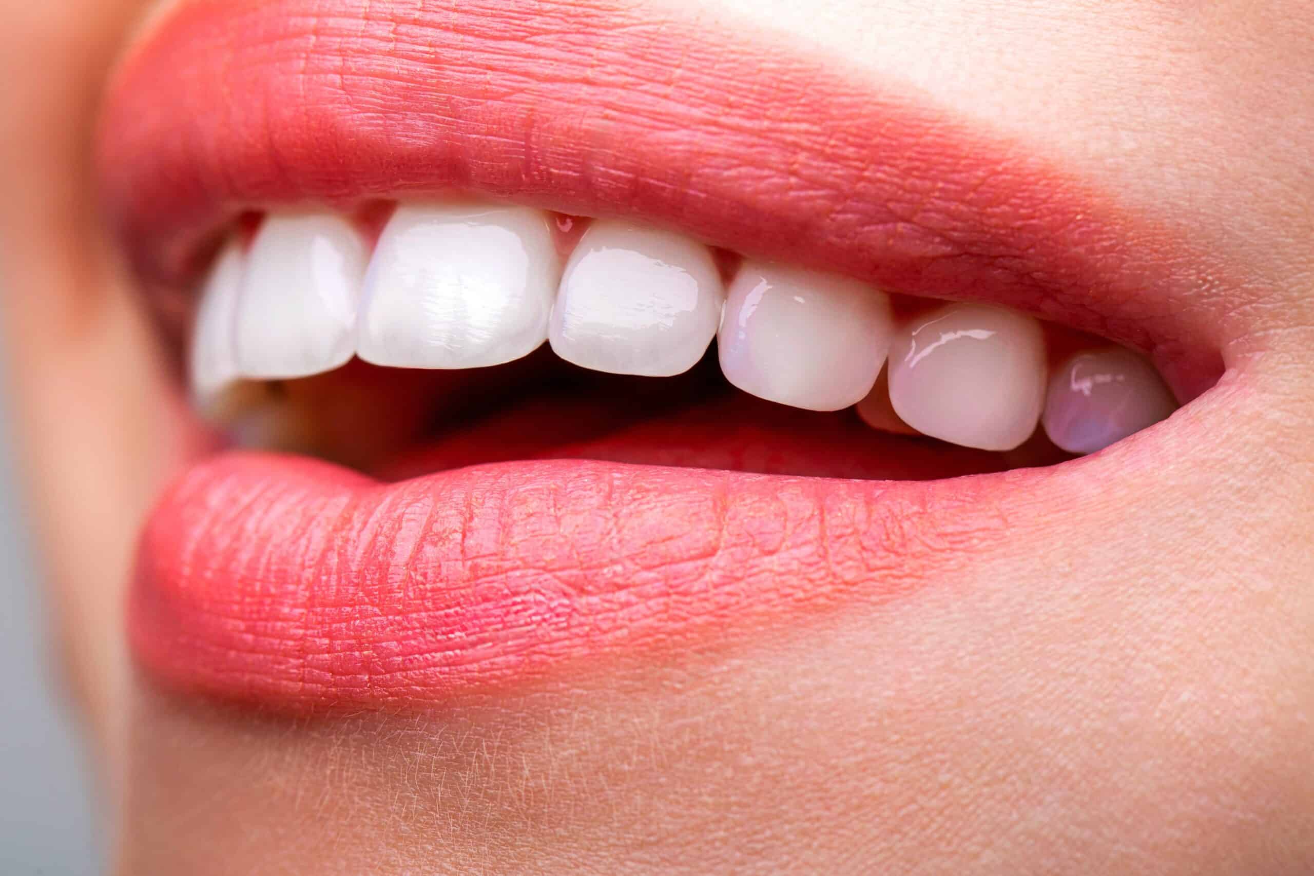 teeth whitening west valley